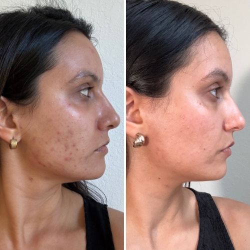 Resultado de quem tomou o shots naturais