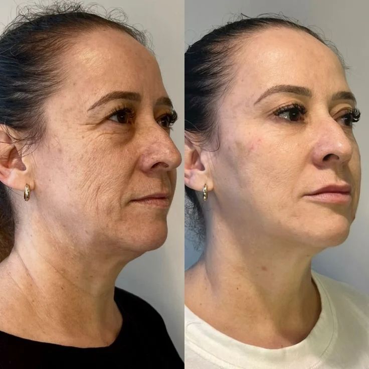 Resultado de quem tomou o shots naturais